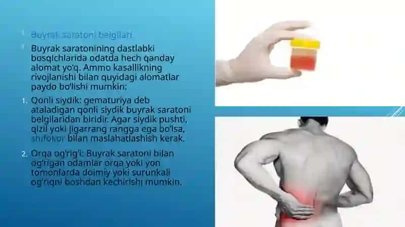 Buyrak saratonining tavsiflanishi 4
