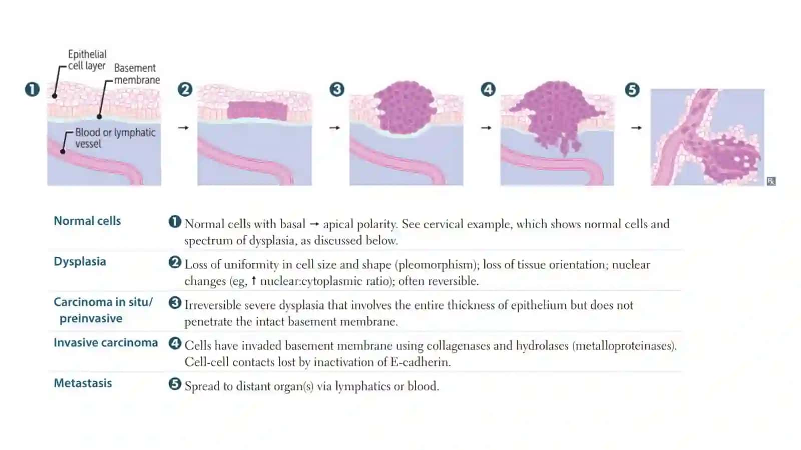 PATOLOGIYA NEOplaziya 1-qism 4