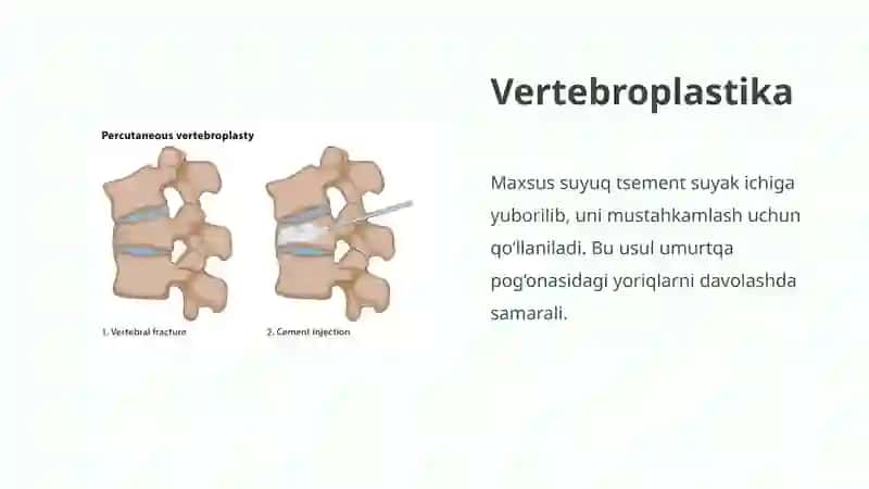 Umurtqapog‘onasi va orqa miyashikastlanishinidavolash 4