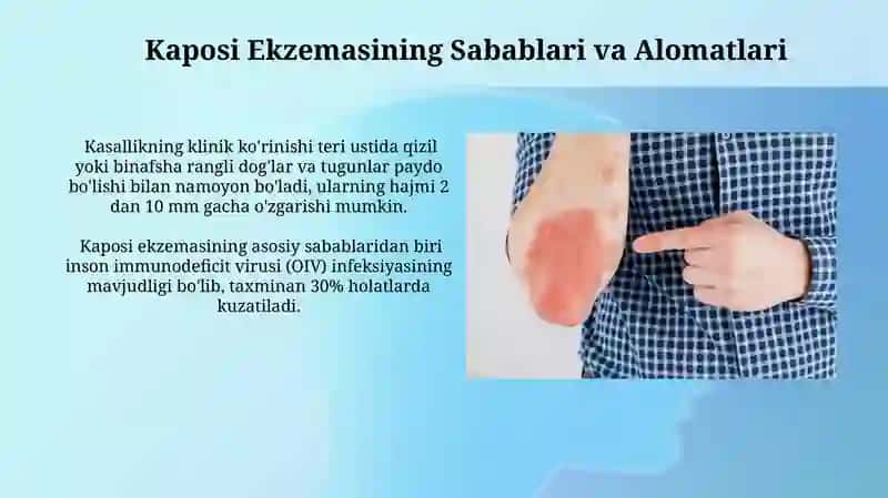Kaposi Sarkomasi va Ekzemasi 4