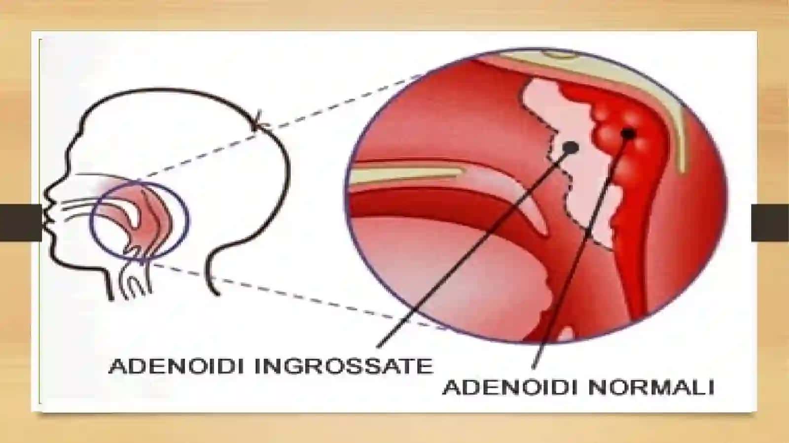 Adenoidlar 4