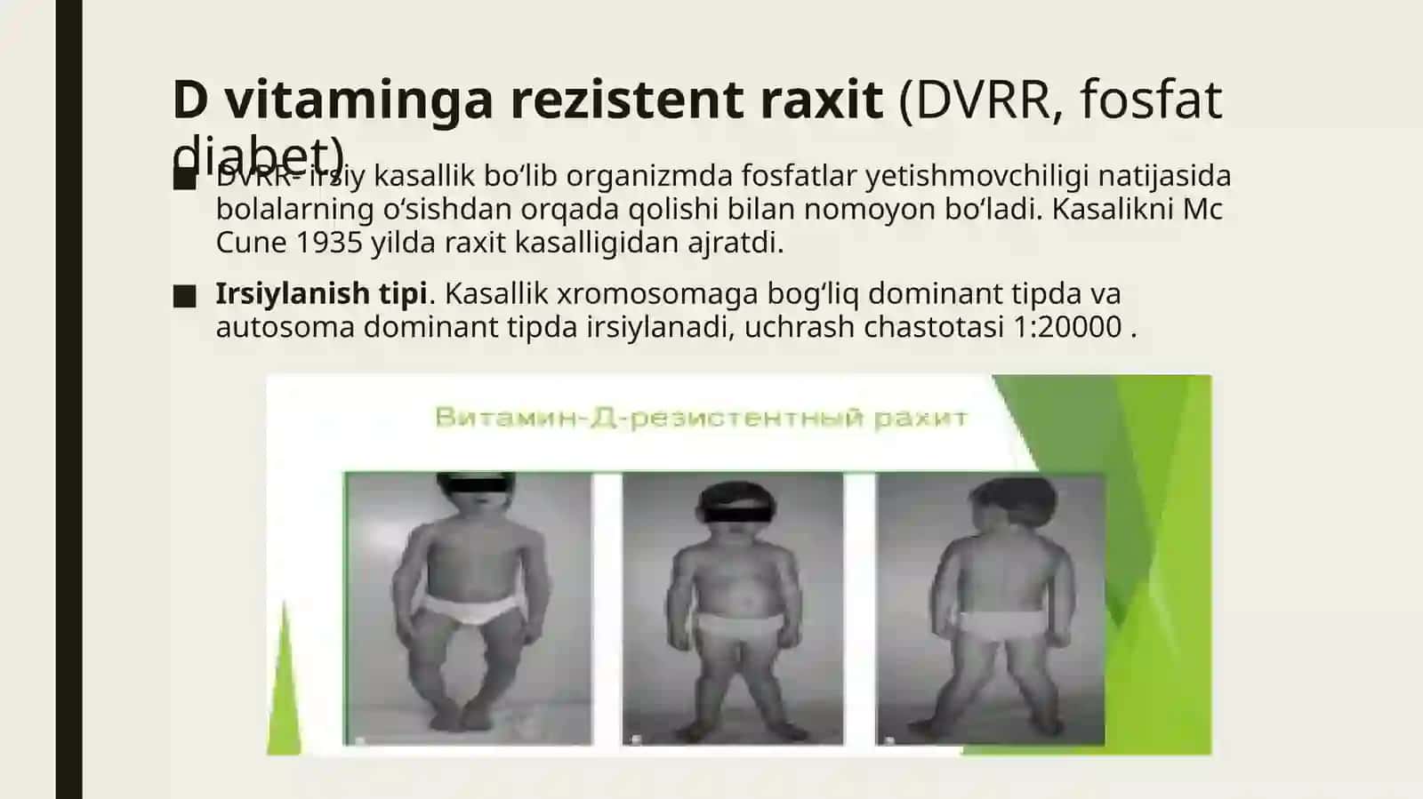 Vitamin D rezistent Raxit,Vitamin D ga qaram Raxit 4