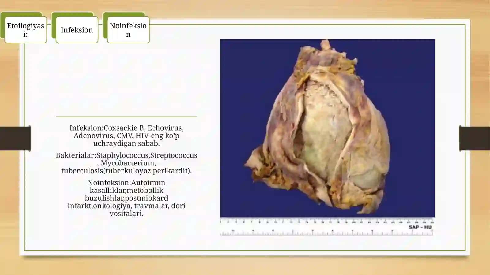 Perikard kasalliklari.Yurak o’smalari.Yurak transplantatsiyasi. 4