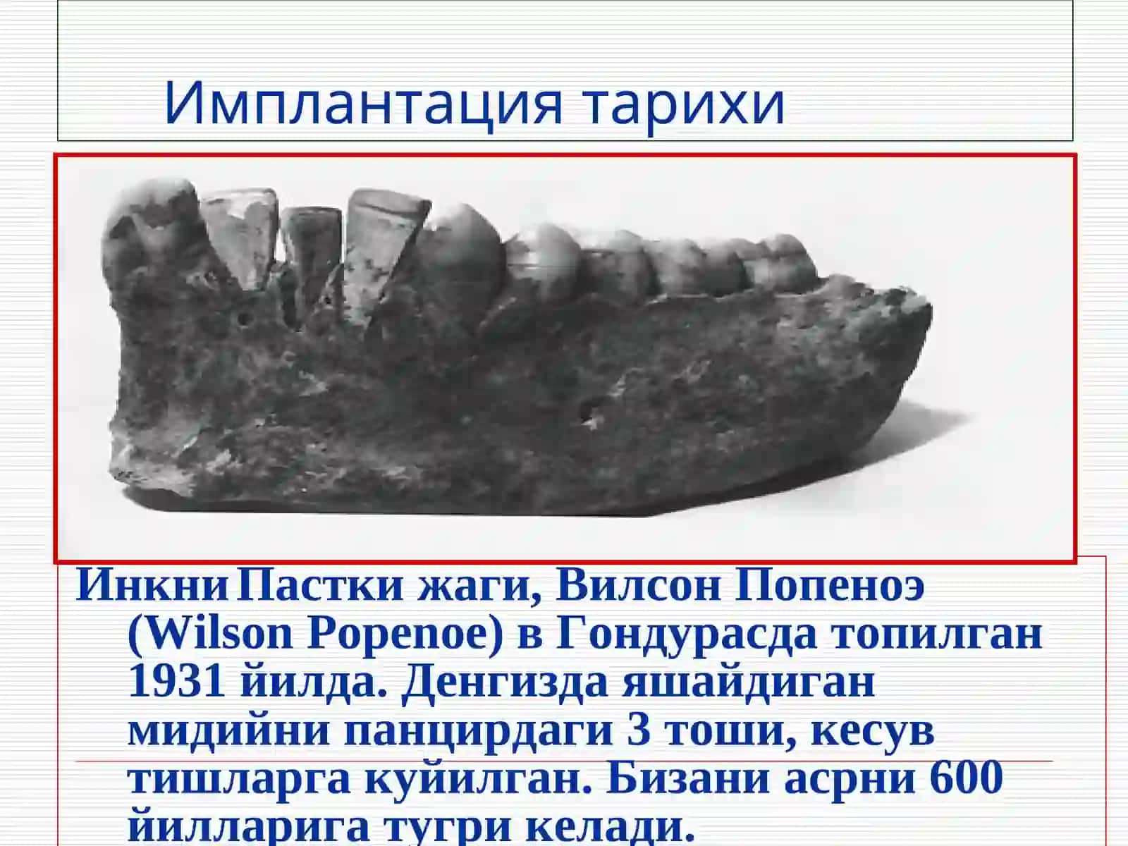 Дентал имплантация тарихи, ишлатадиган материаллар ва уларнинг таснифи. Дентал имплантацияга курсатма ва карши курсатмалар. Жаглардаги альвеоляр усигни атрофияси,таснифи. Жаглар альвеоляр усиги калинлиги ва баландлигини тиклаш уссуллари 4