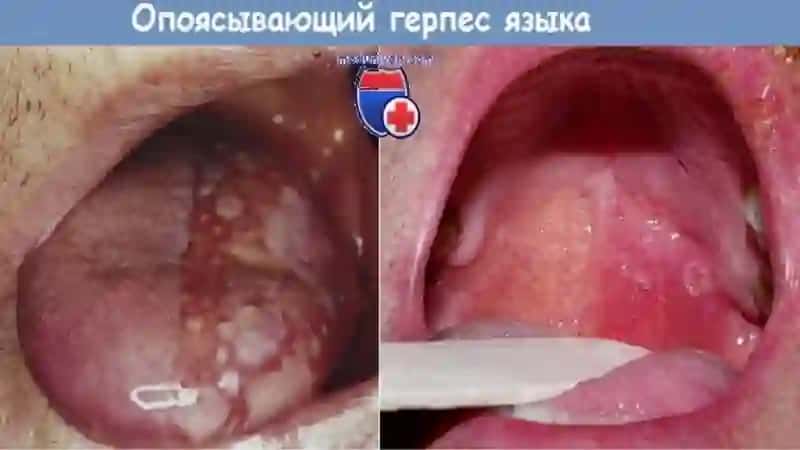 Virus kasalliklarini OBShQda 4