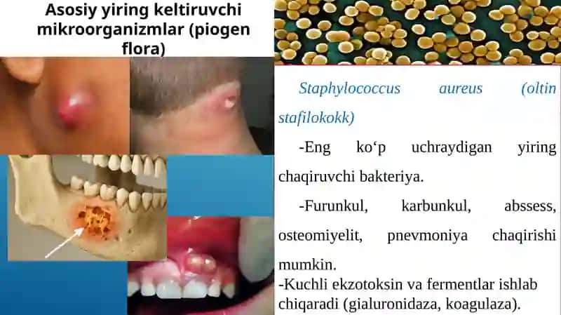 Yiringli yallig‘lanish jarayonlarini keltirib chiqaruvchi mikroorganizmlar 4