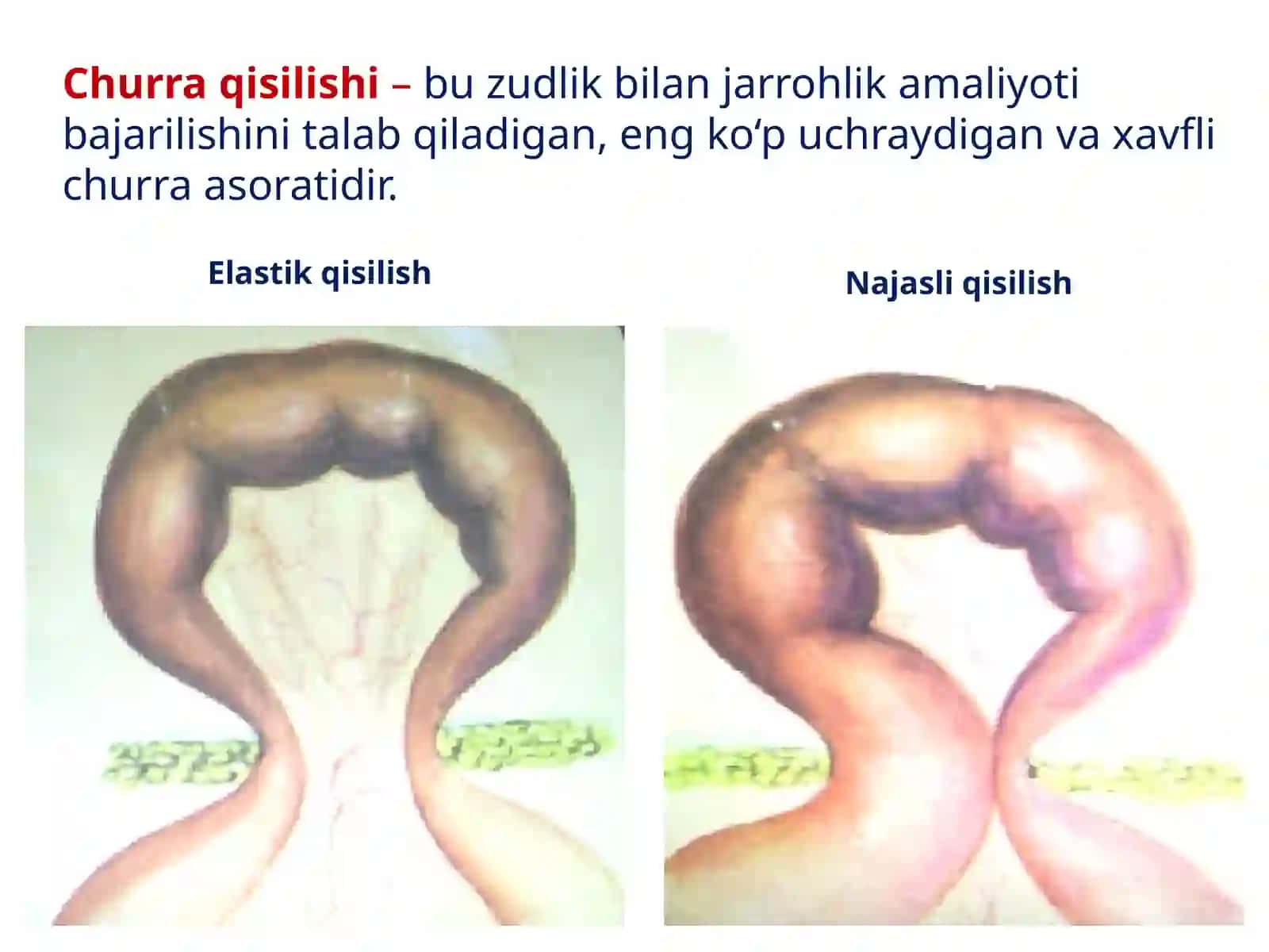 Qorin Churralari Va Ularning Asoratlari 4