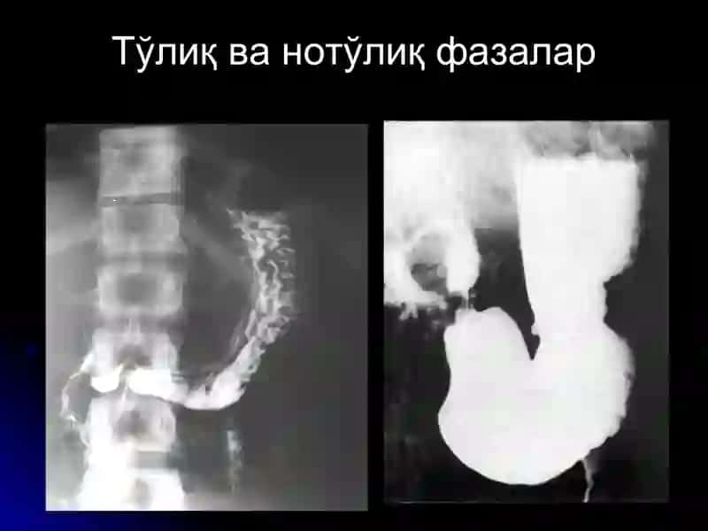 ОШКОЗОН-ИЧАК КАСАЛЛИКЛАРИ НУР ТАШХИСИ 4