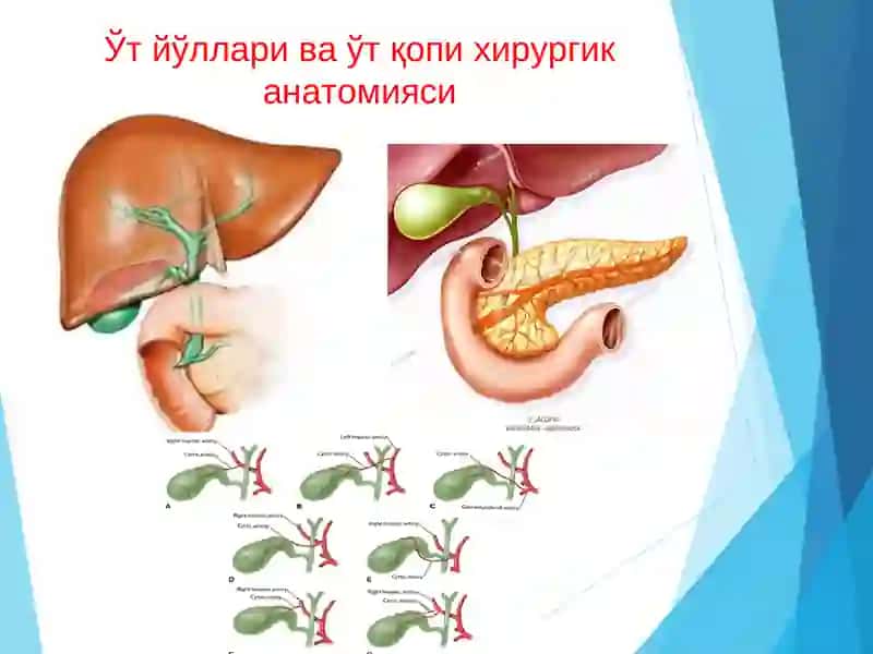 Ўт тош касаллиги 4