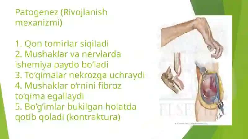 Folkman(Volkmann) ishemik kontrakturasi 4