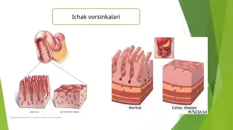Seliakiya kasalligi 4