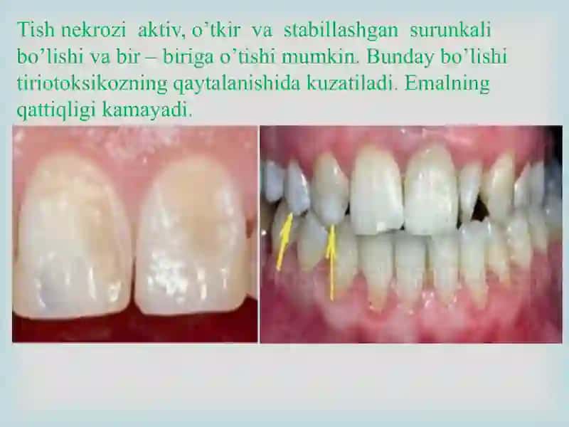 Tish chiqqandan keyin paydo bo’ladigan nokariyes kasalliklar. Tish qattiq  to’qimasi eroziyasi. Klinikasi, tashxislash va qiyosiy tashxislash. 4