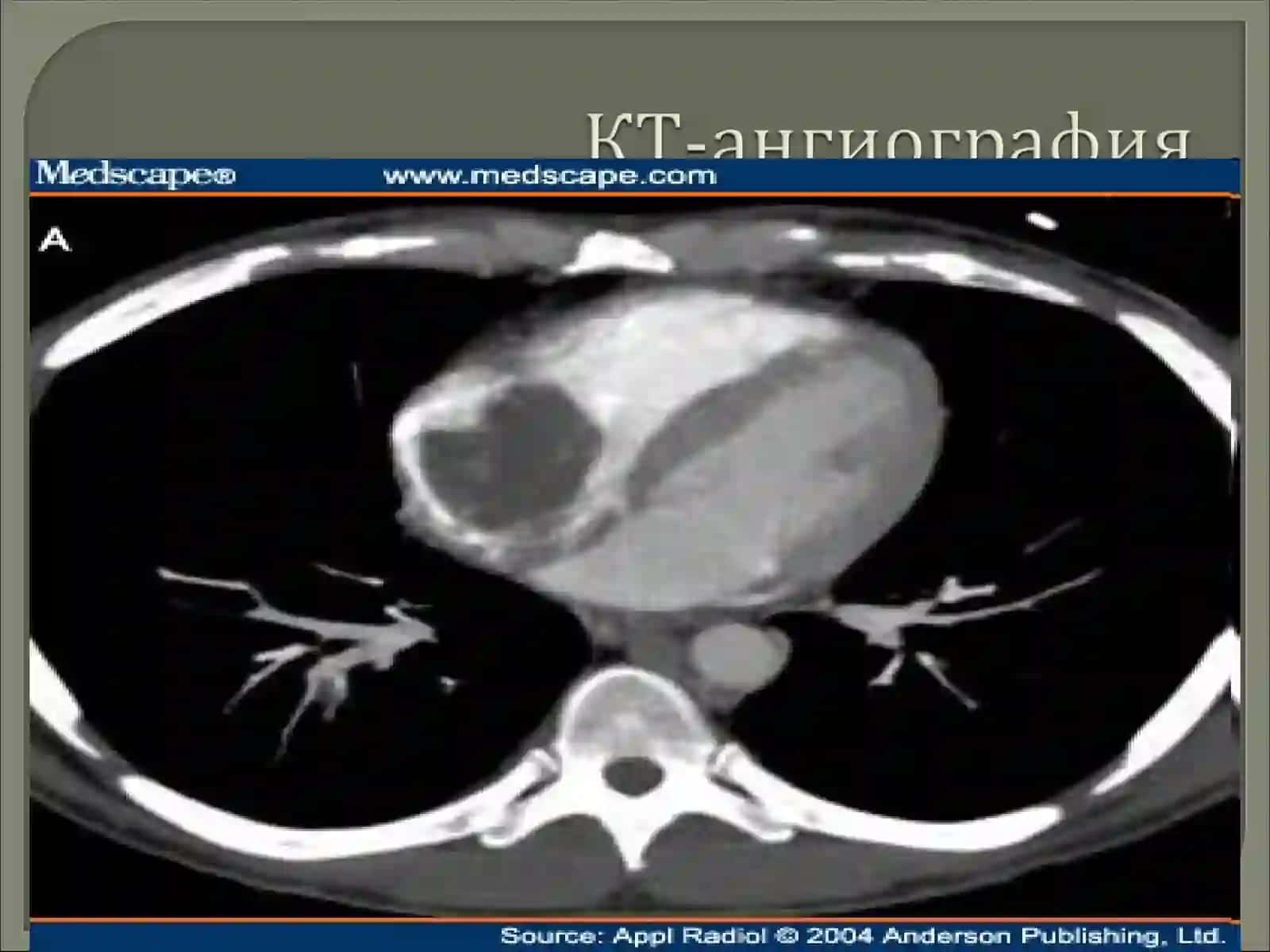 YURAK-QON TOMIRLARI KASALLIKLARIDA KOMPYUTER TOMOGRAFIYANING AXAMIYATI 4