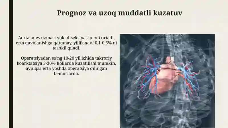 Aorta koarktatsiyasi 4