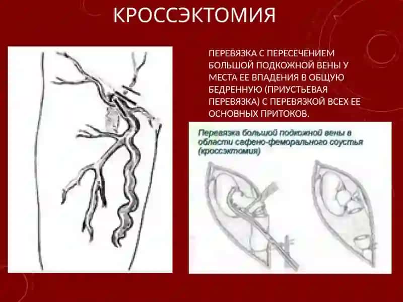 СОВРЕМЕННЫЕ МЕТОДЫ ХИРУРГИЧЕСКОГО ЛЕЧЕНИЯ ВАРИКОЗНОЙ БОЛЕЗНИ НИЖНИХ КОНЕЧНОСТЕЙ 4