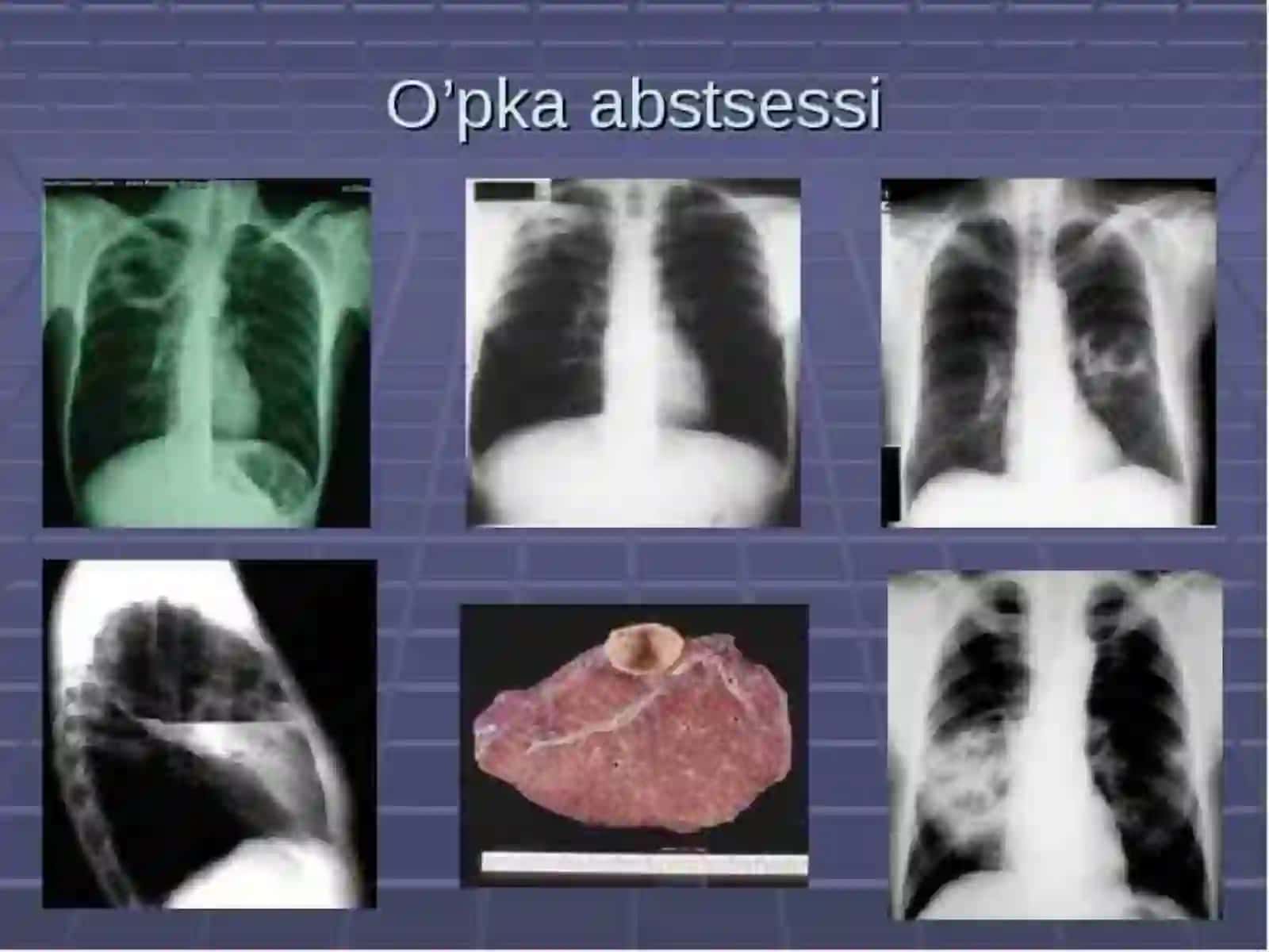 O’pkaning yiringlik kasalliklari. O’pka absessi va gangrenasi 4