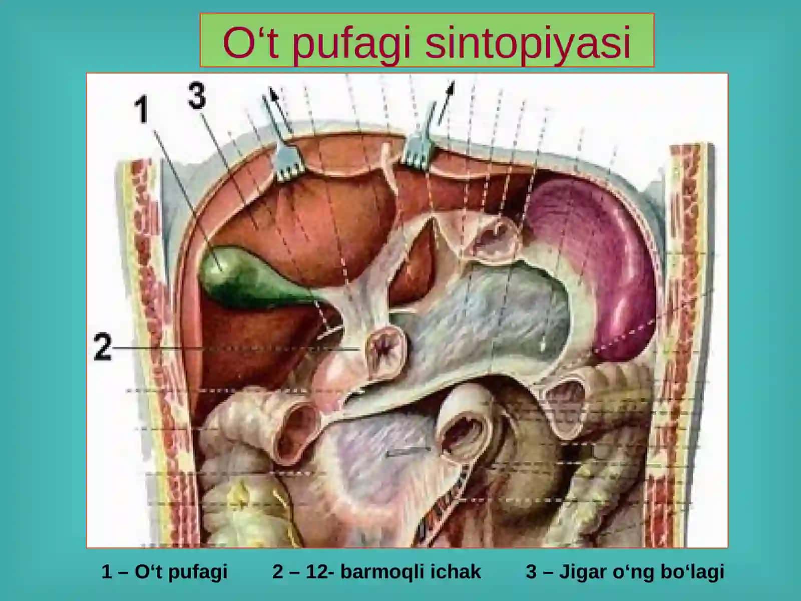O‘t tosh kasalligi. Xoletsistitlar, diagnostikasi va davolash 4