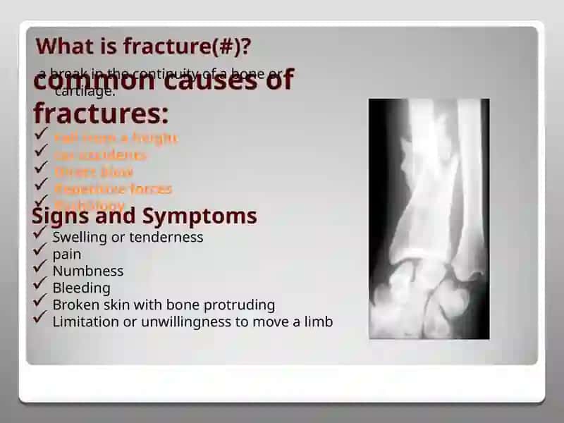 Fractures 4