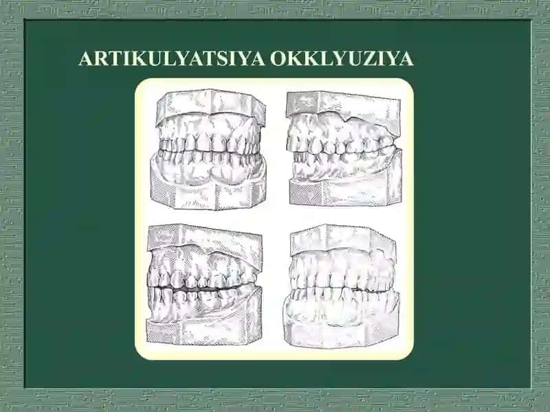 Ortopedik stomatologiya bo‘limida Artikulatsiya va oklyuziya, ularning turlari 4