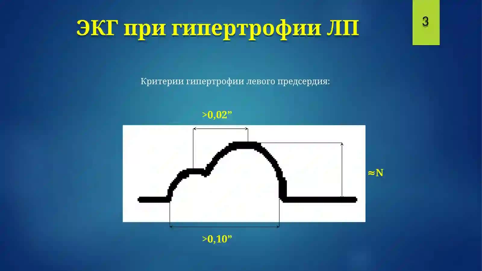 ЭКГГипертрофии, блокады 4