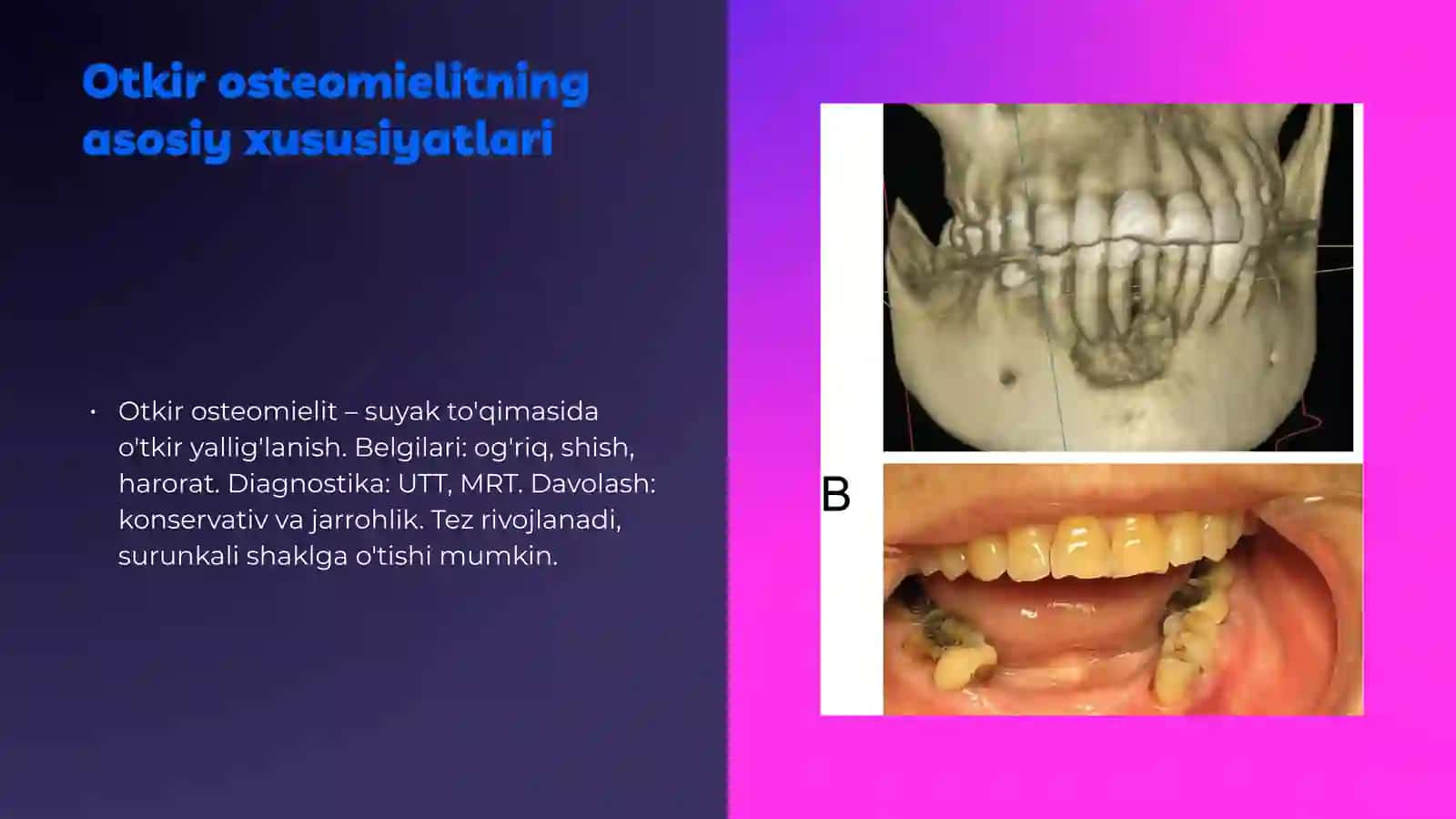 Otkir odontogen osteomielitning tasnifi va asosiy xususiyatlari 4