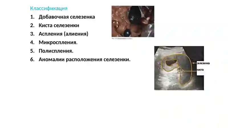 Аномалии развития селезенки 4