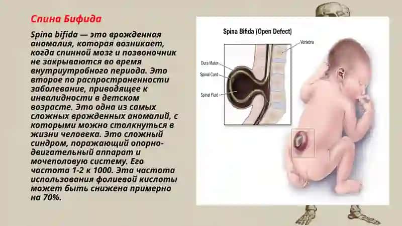 Аномалии скелета 4