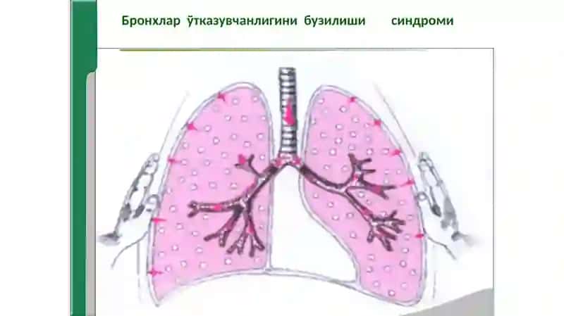 Нафас  системаси  касалликларидаги  асосий  клиник  синдромлар 4