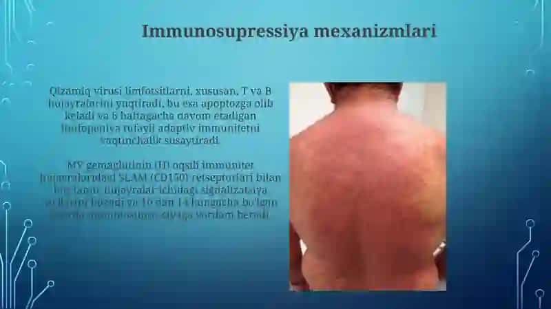 Qizamiq virusi: immunosupressiya mexanizmi va klinikasi 4