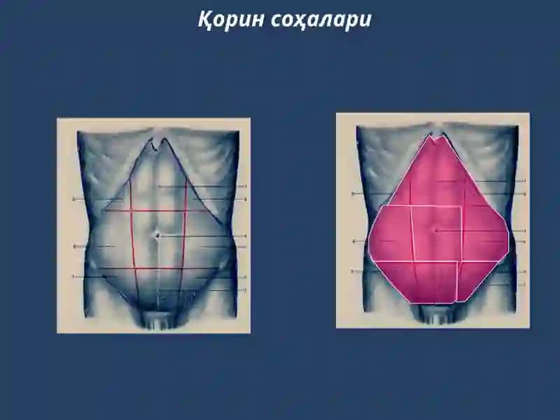 Гинекологик перитонитлар 4
