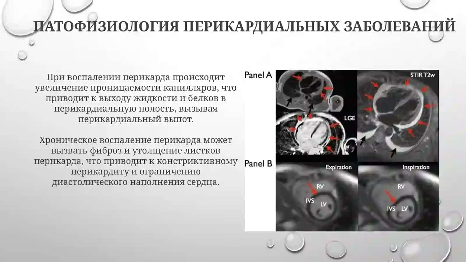 Нарушения функции сердца при патологии перикарда 4
