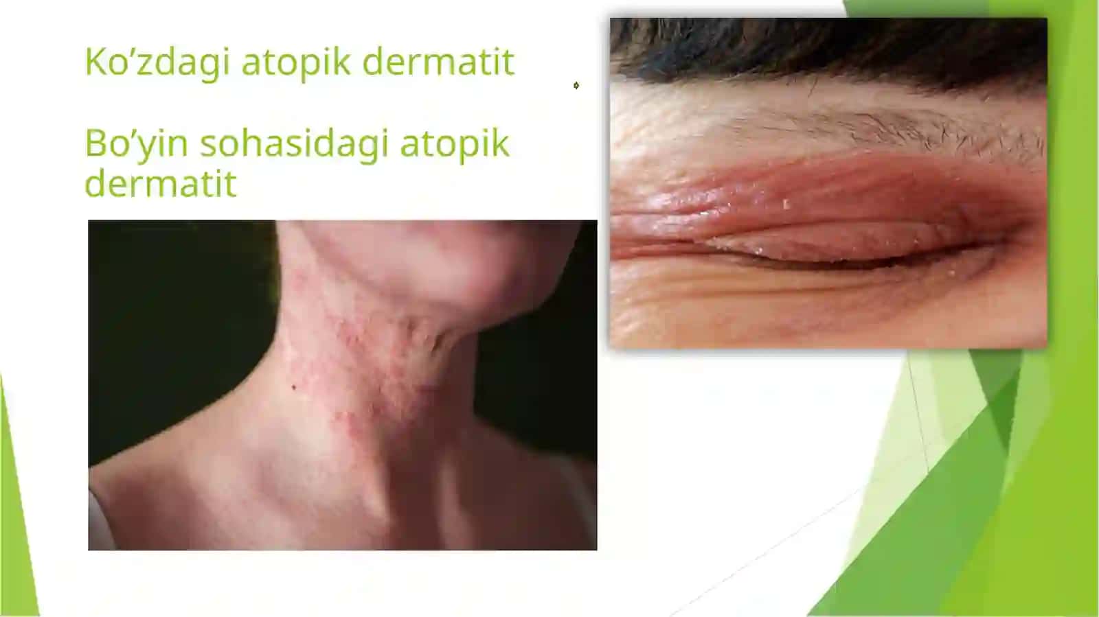 ATOPIK DERMATIT 4
