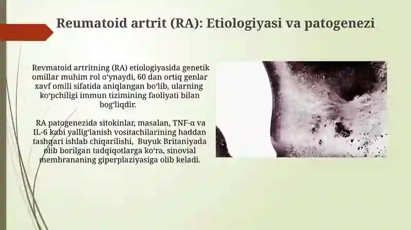 Osteoartrit: Klinik ko'rinishlari va diagnostikasi 4