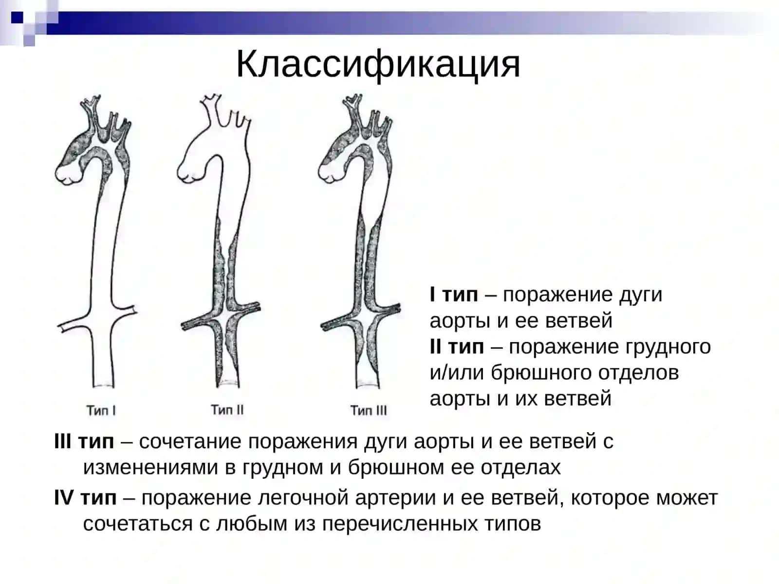 Болезнь Такаясу (неспецифический аортоартериит,синдром дуги аорты) 4