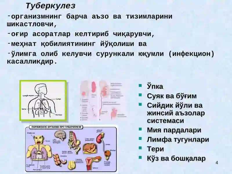 СИЛ ЭПИДЕМИОЛОГИЯСИ, СИЛ ⱩЎЗҒАТУВЧИСИ, ОҒИЗ БЎШЛИҒИ СИЛИ, КЛИНИК КЕЧИШИ. СИЛНИ ДАВОЛАШ ВА ОЛДИНИ ОЛИШ. 4