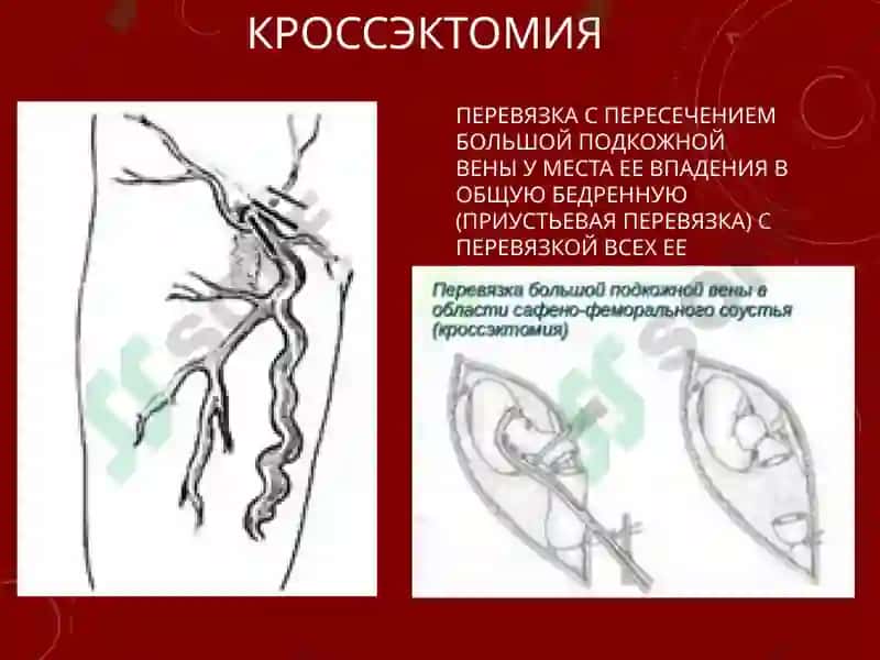 СОВРЕМЕННЫЕ МЕТОДЫ ХИРУРГИЧЕСКОГО ЛЕЧЕНИЯ ВАРИКОЗНОЙ БОЛЕЗНИ НИЖНИХ КОНЕЧНОСТЕЙ 4