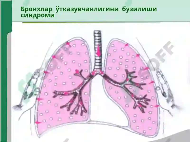 Нафас органлари касалликларида асосий клиник синдромлар 4
