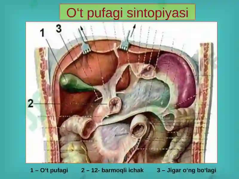 O‘t tosh kasalligi. Xoletsistitlar, diagnostikasi va davolash 4