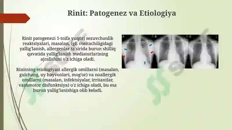 Yuqori nafas yo’llari yallig’lanish kasalliklarida (rinit) F. Yo tamoillari 4