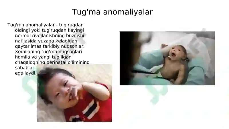 Bosh miyya va orqa miyya tug'ma rivojlanish nuqsonlari 4