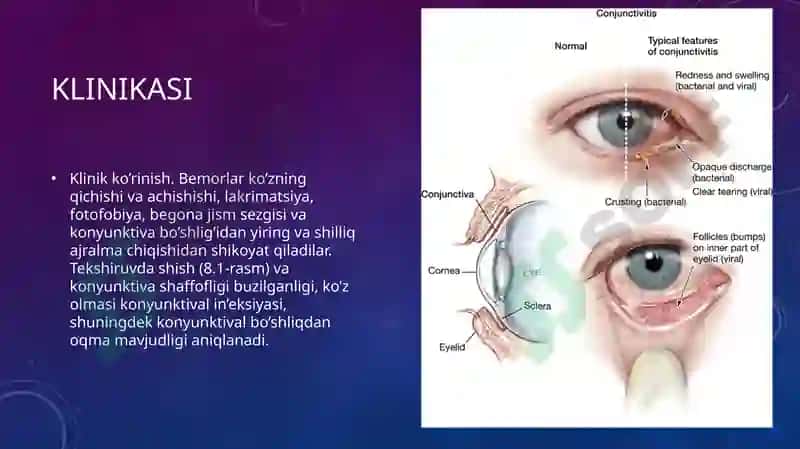 Kon’yunktivitlarnibirdanepidemikavjolishinioldiniolishbo`yichaprofilaktikchoratadbirlar 4