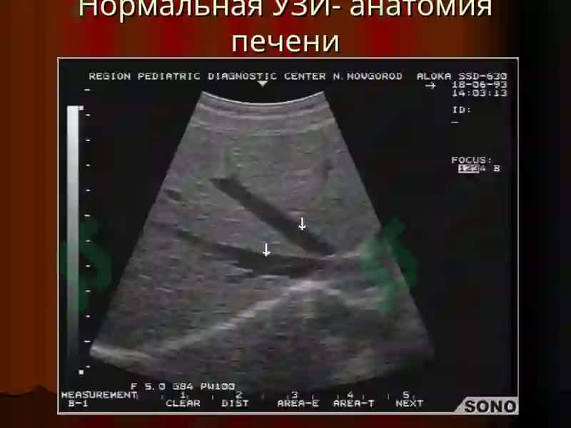 Лучевая диагностика заболеваний печени и желчевыводящих путей 4