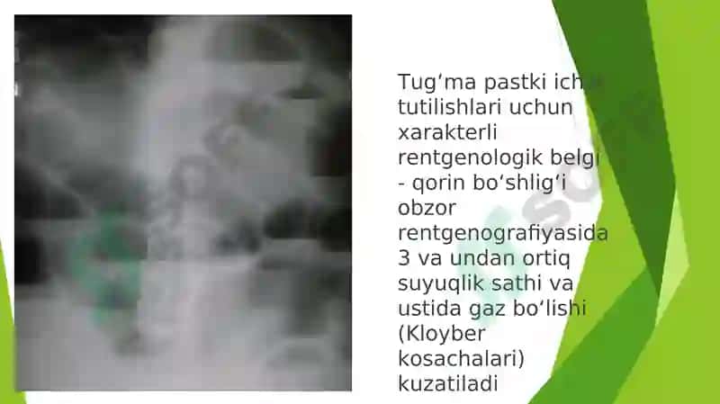 Pastki ichak tutilishlari 4