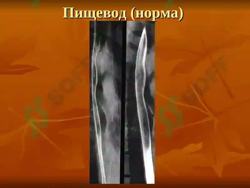 Лучевая диагностика заболеваний желудочно-кишечного тракта 4