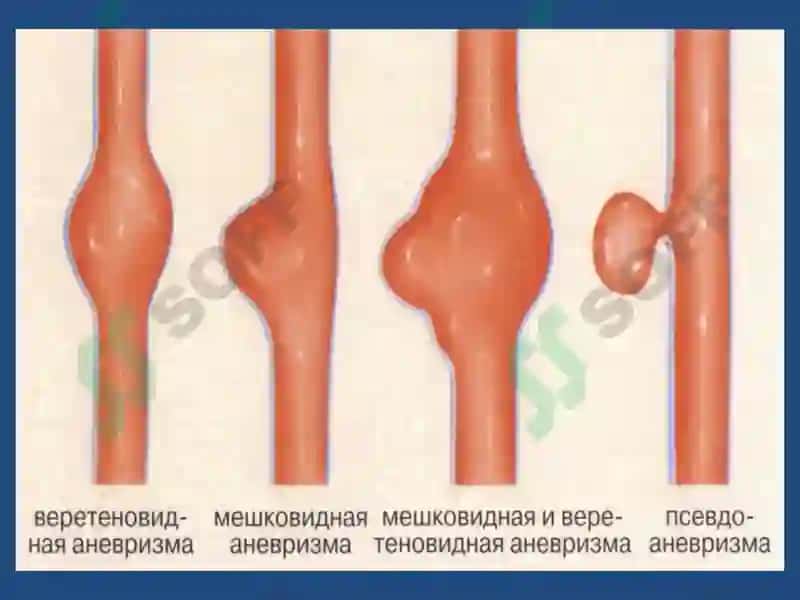 Сосудистая патология головного мозга 4