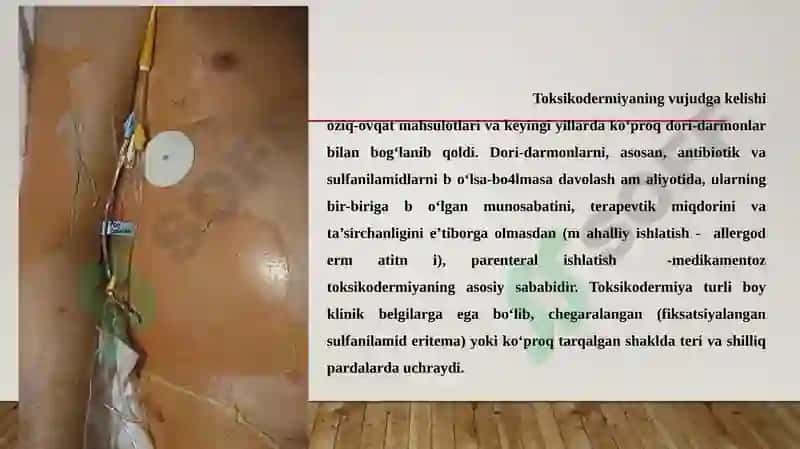 Layell va Stivens-Djonson sindromlari 4