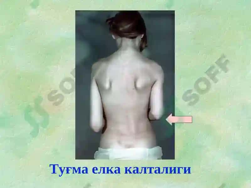 Туғма оёқ-қўл нуқсонлари 4