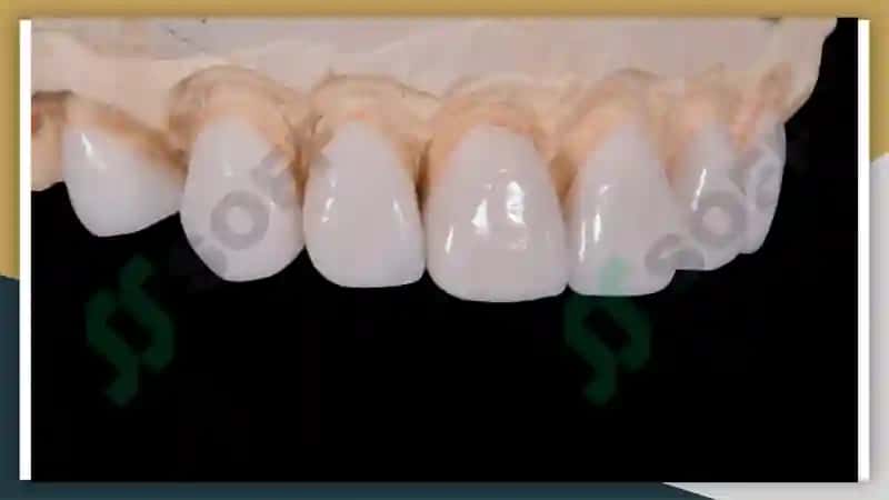 Ortopedik stomatologiyada qo‘llaniladigan asosiy materiallar 4