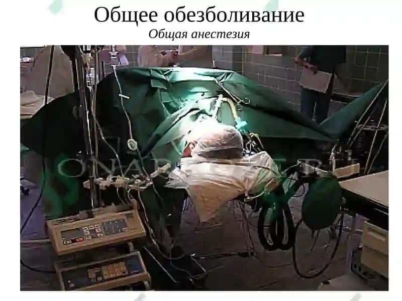 Общее обезболивание 4