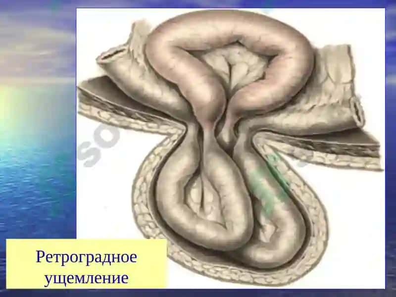 Осложнения грыж живота 4